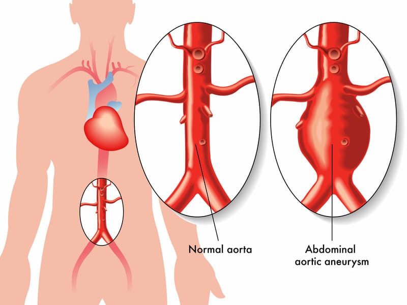 abdominal-aortic-aneurysm-repair-report-the-correct-cpt-codes