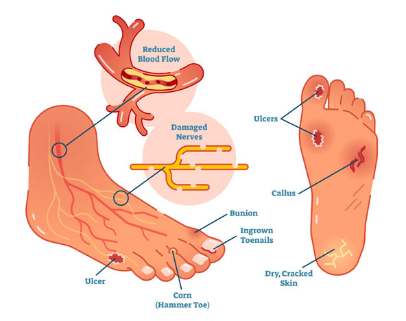 family-footcare-services-diabetic-foot