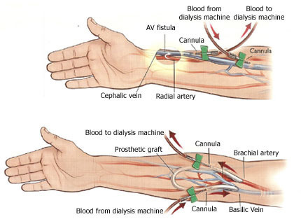 fistula for dialysis placement