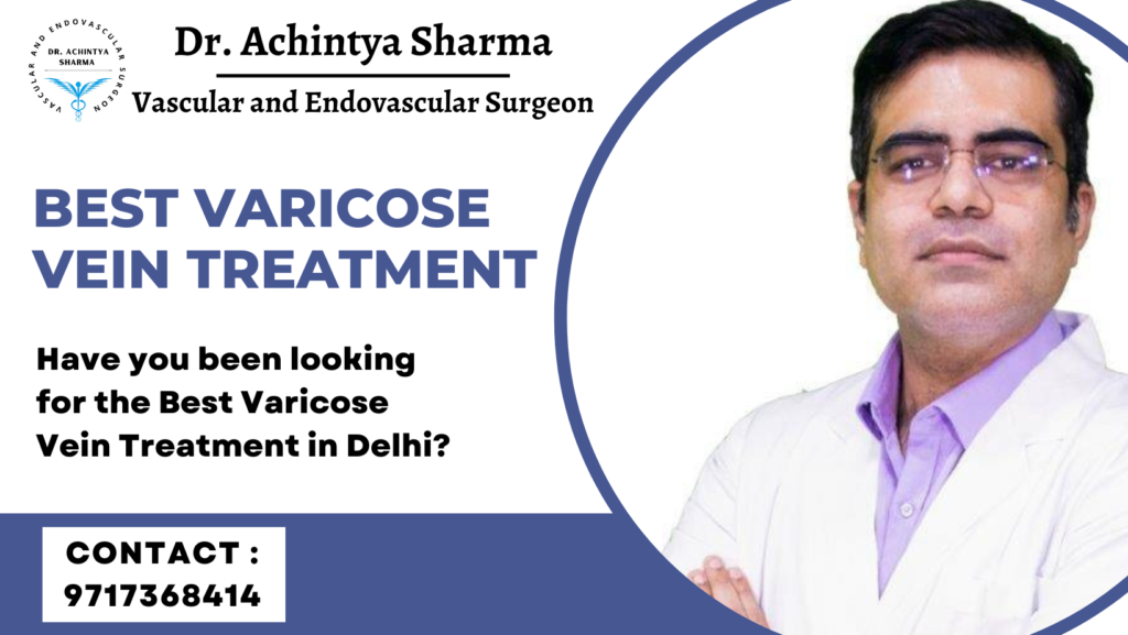 Best Varicose Vein Treatment