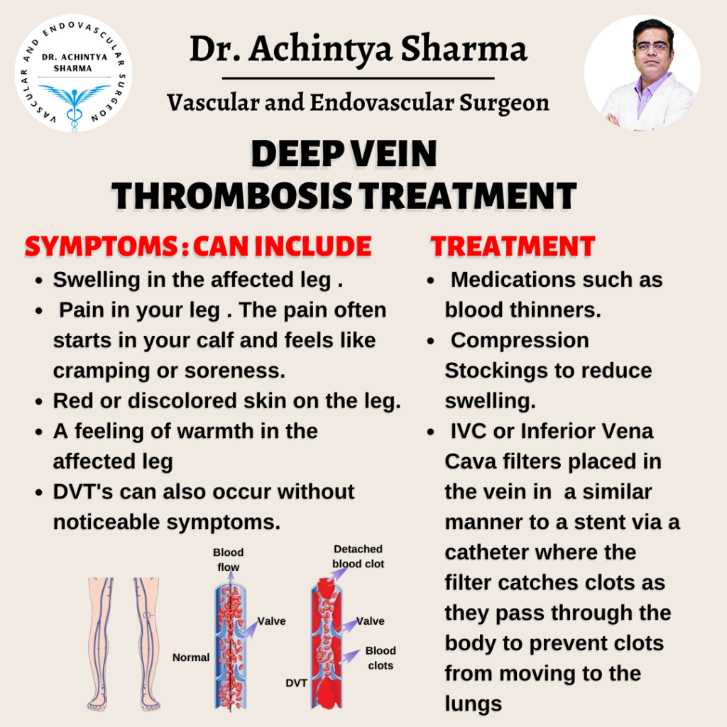 Things you want to know about Deep Vein Thrombosis Treatment