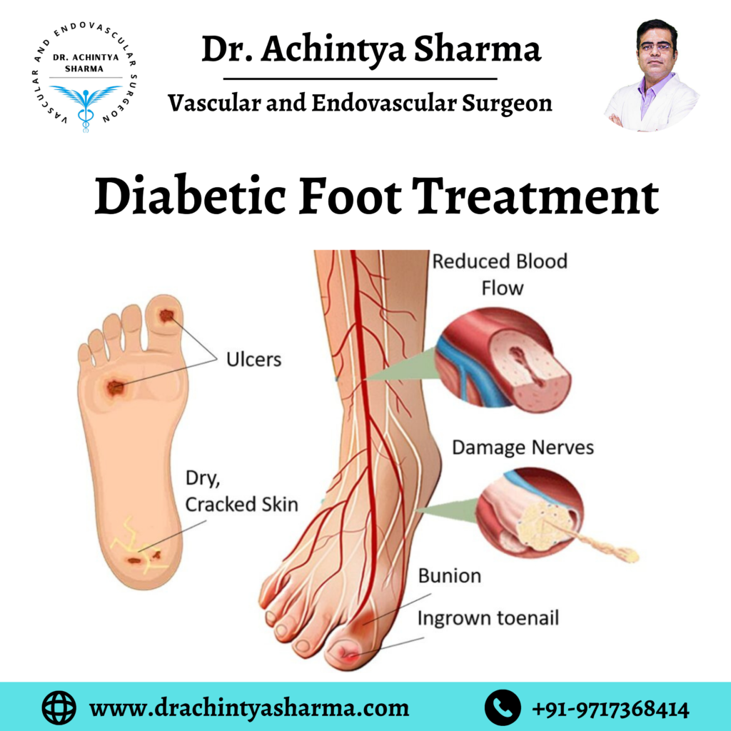 Diabetic foot treatment