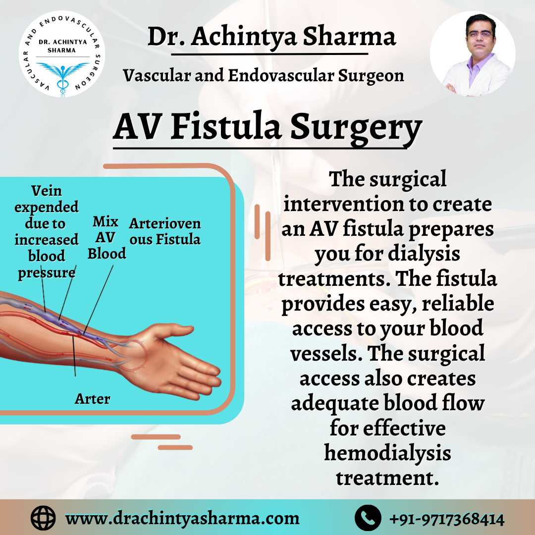 av-fistula-surgery