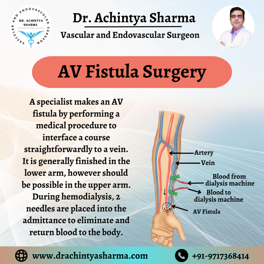 AV Fistula Surgery