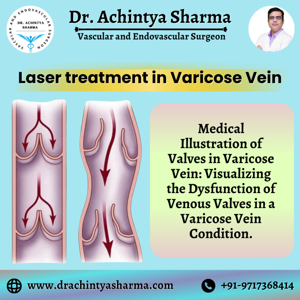 Laser Treatment for varicose vein 