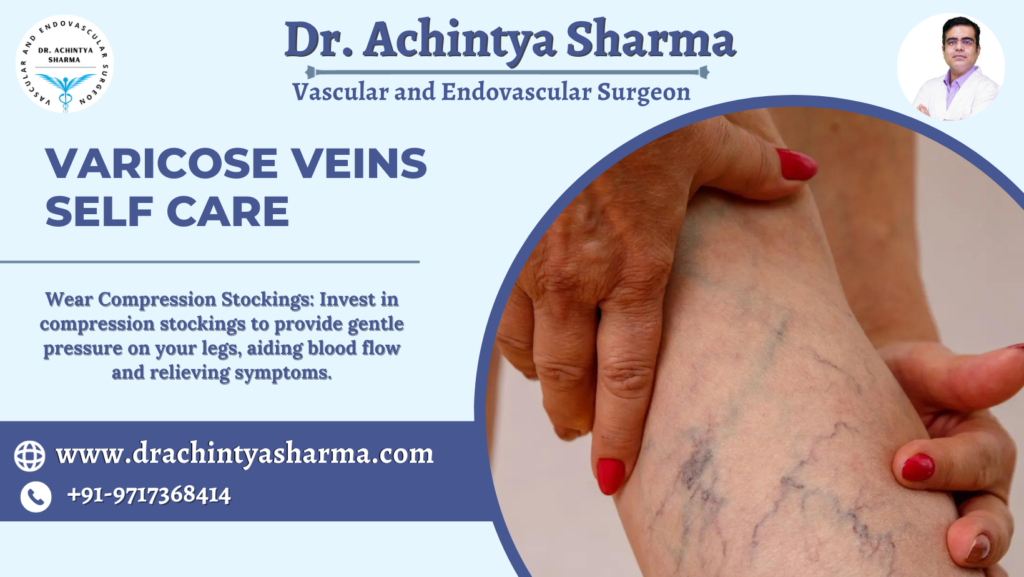 varicose vein self-care