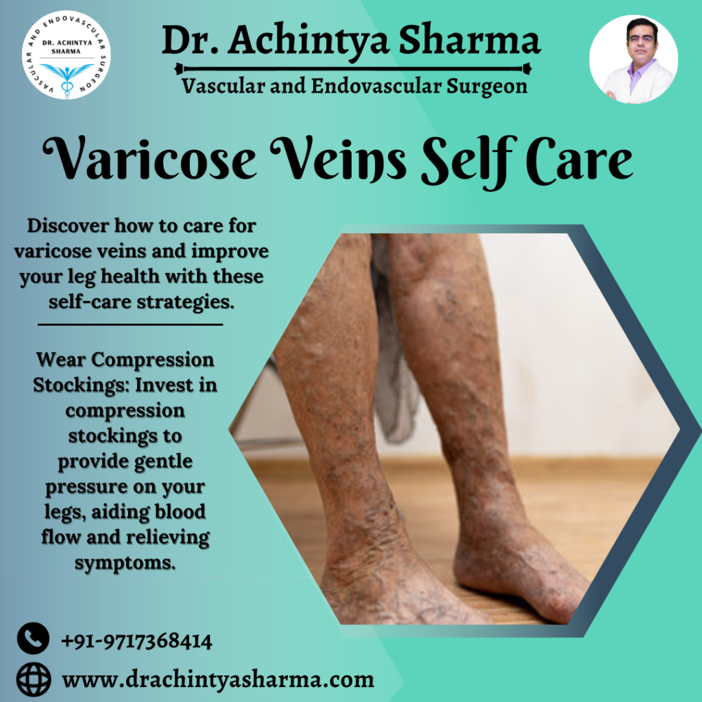 Varicose vein self-care