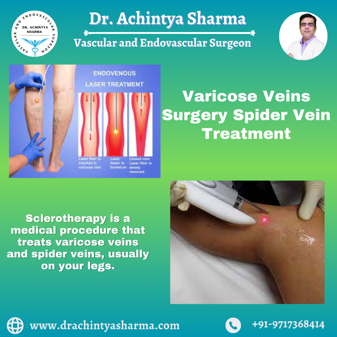 Guide To Varicose Veins Surgery Spider Vein Treatment