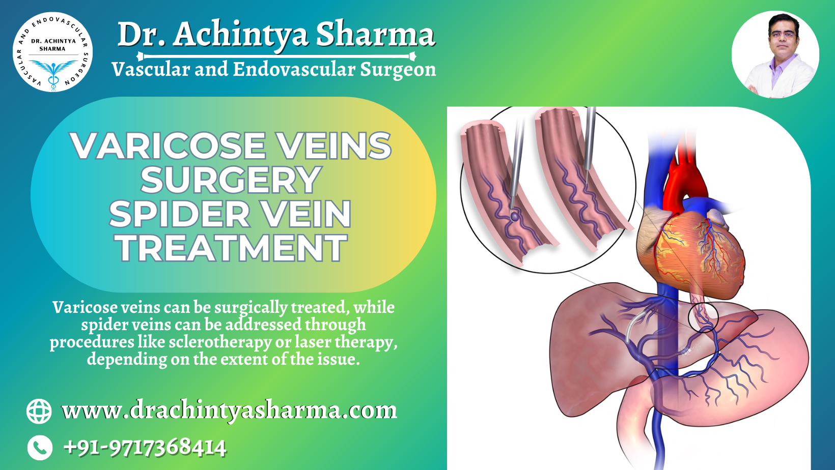 Sclerotherapy of spider veins - Vascular Care Centre