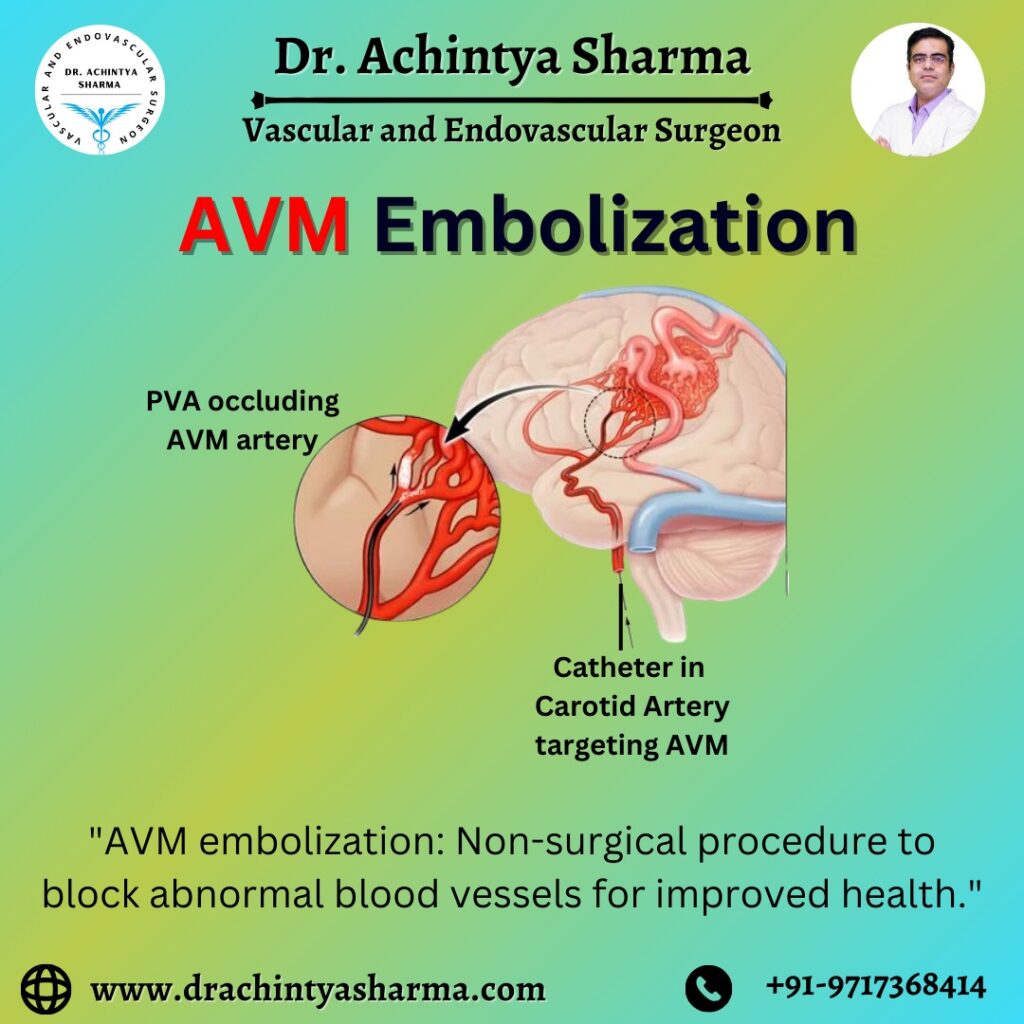 arteriovenous malformation embolization