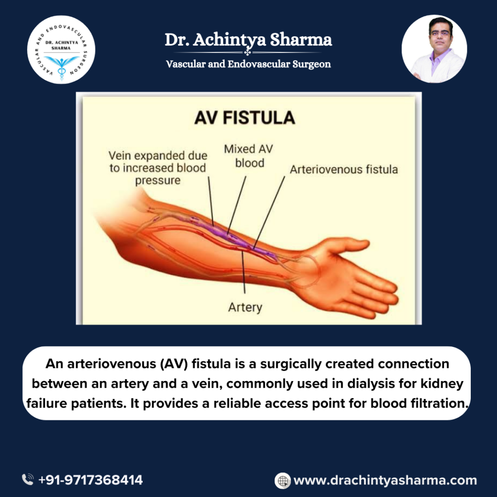 Fistula Surgery for Dialysis
