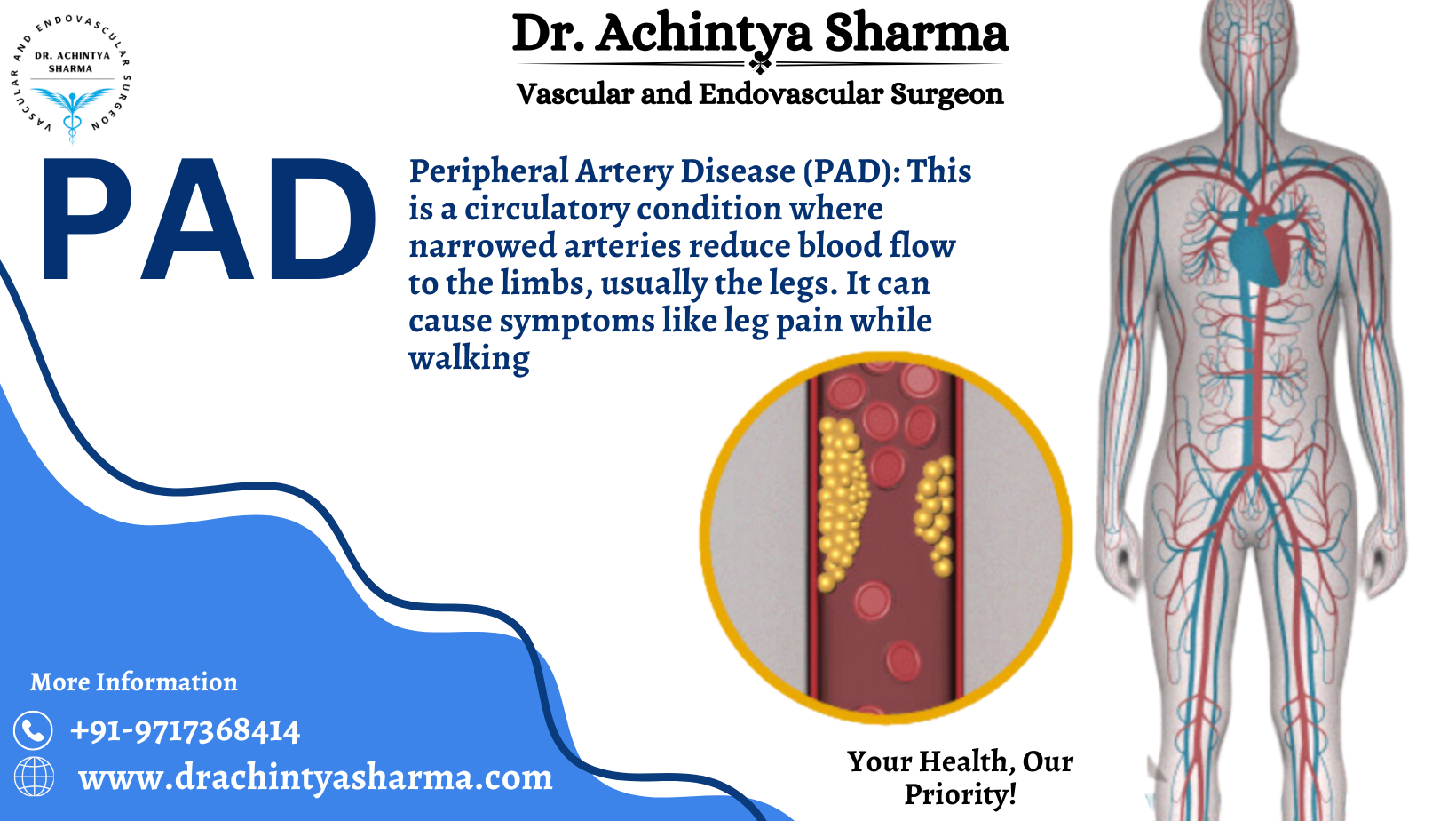 Discovering newer ways to cure Peripheral Arterial Disease