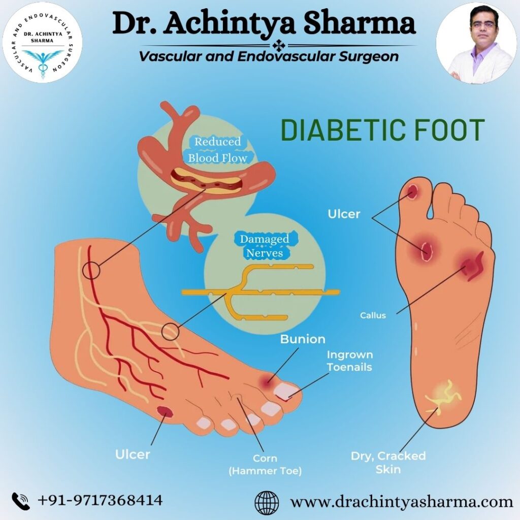 Image of a diabetic foot ulcer showing an open wound on the bottom of the foot 