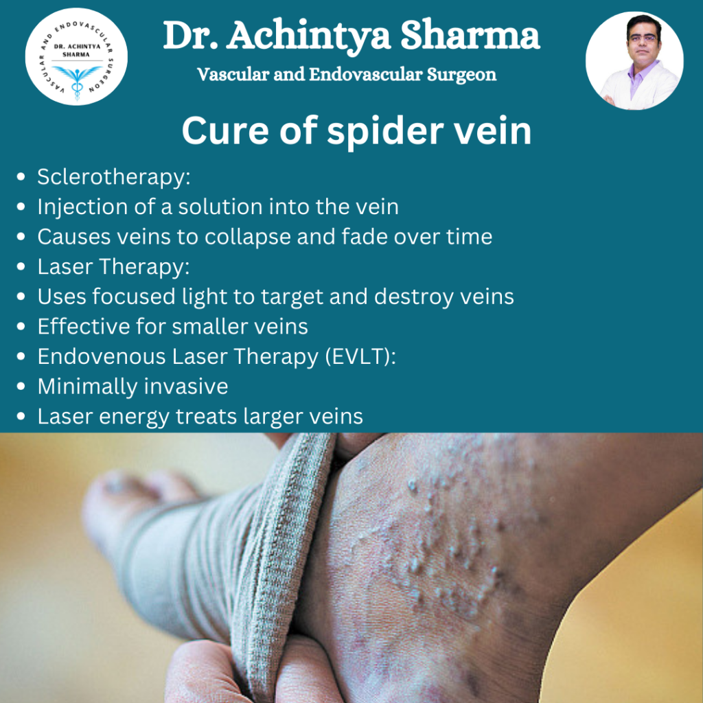 Spider veins