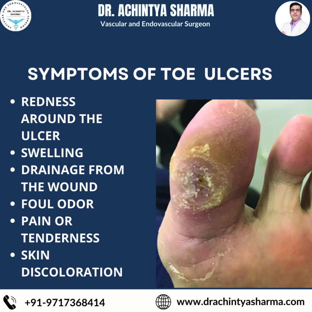 Diabetic toe ulcer