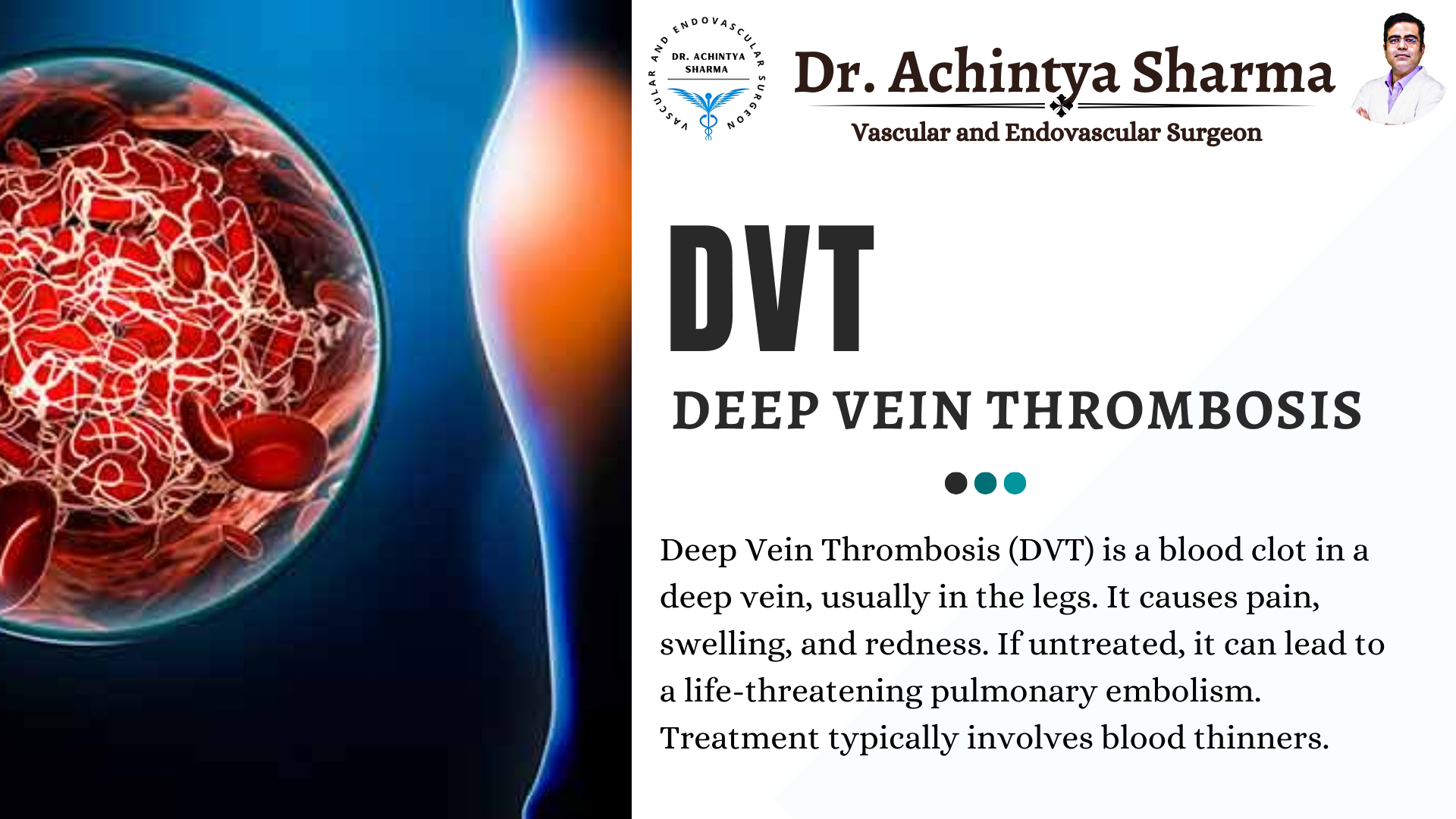 Comprehensive Guide to Deep Thrombosis Treatment: Effective Strategies and Solutions