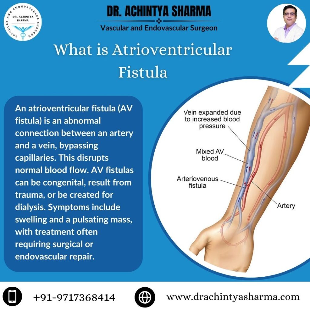 Av fistula 