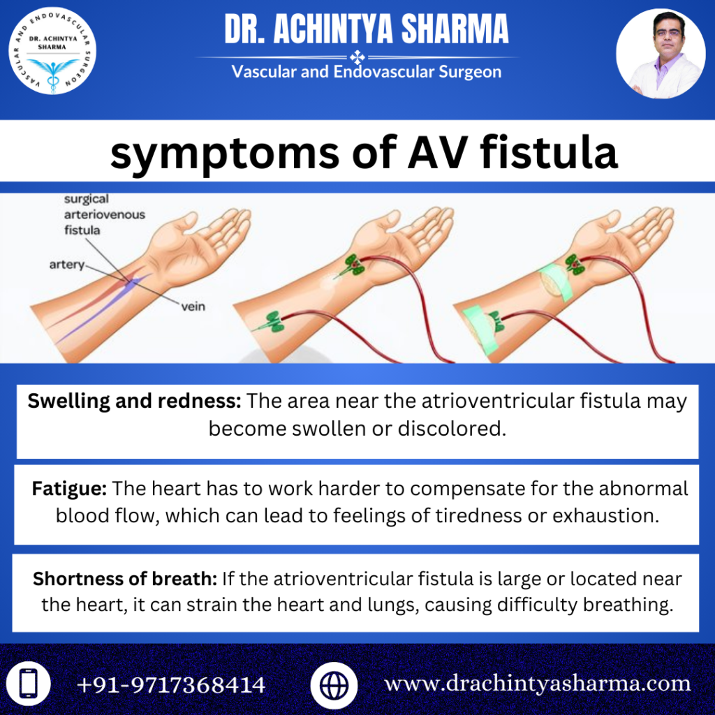 Av fistula 