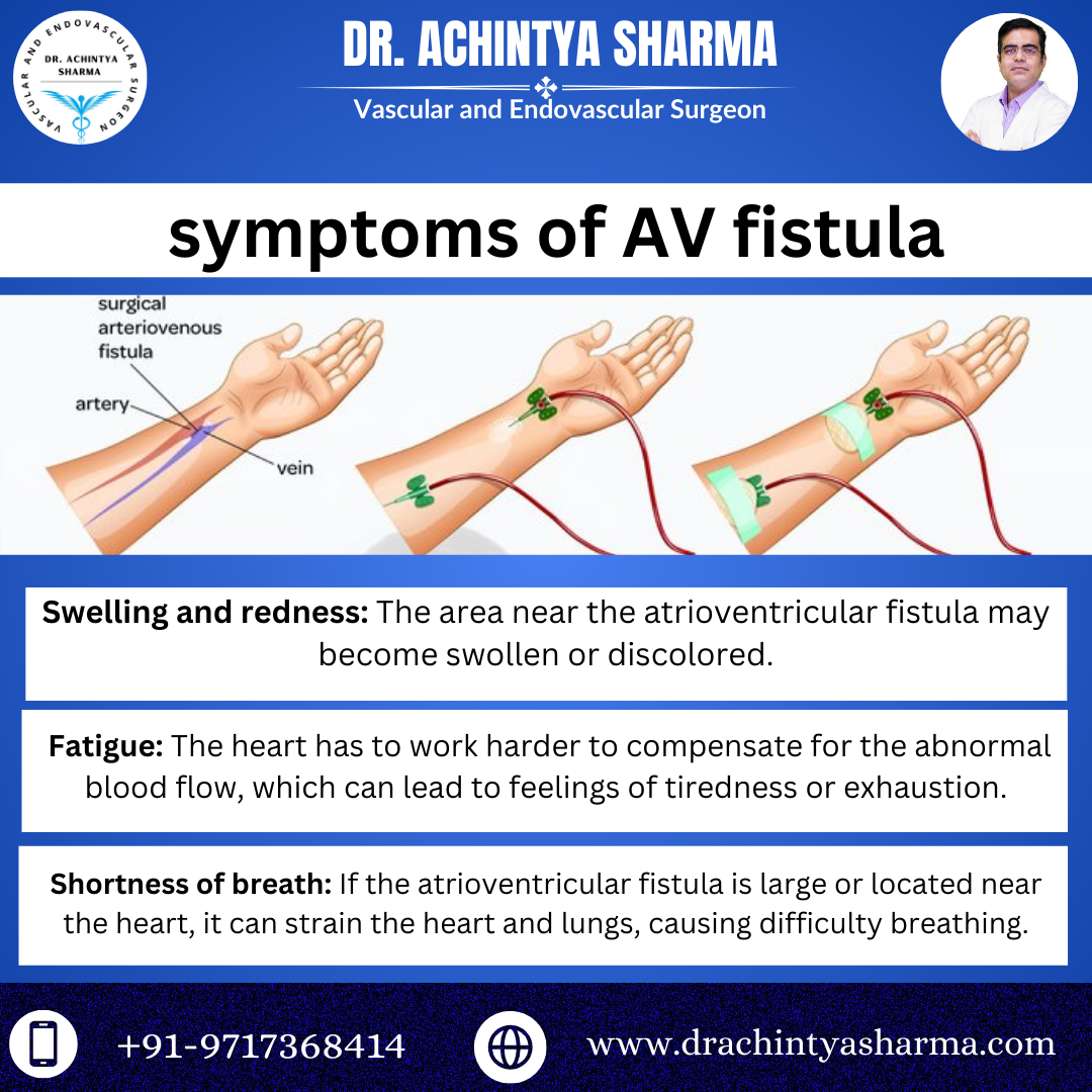 Atrioventricular FistulaThe Hidden Connection Affecting Your Heart.