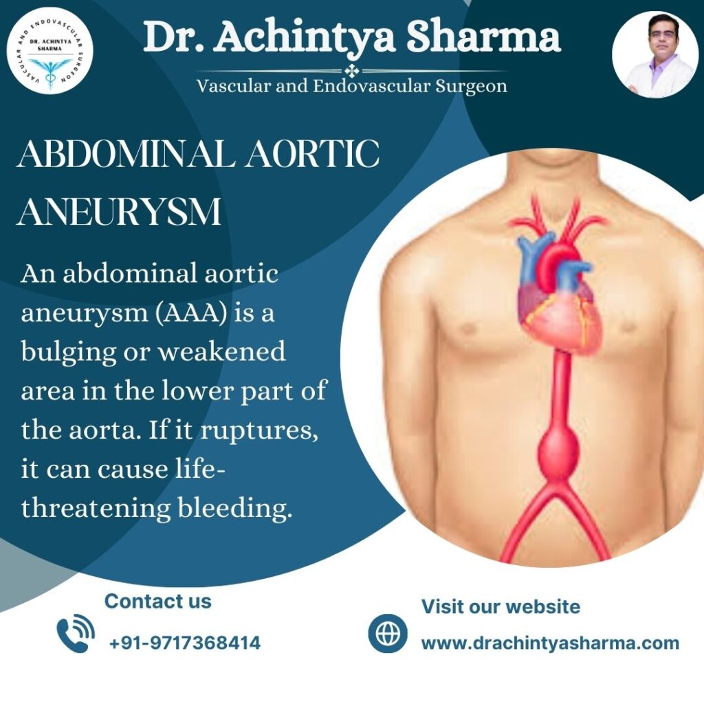 Aortic Aneurysm