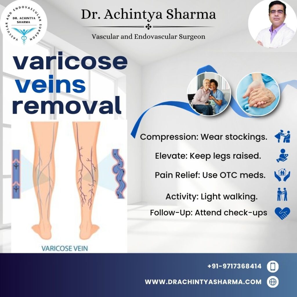 varicose veins removal