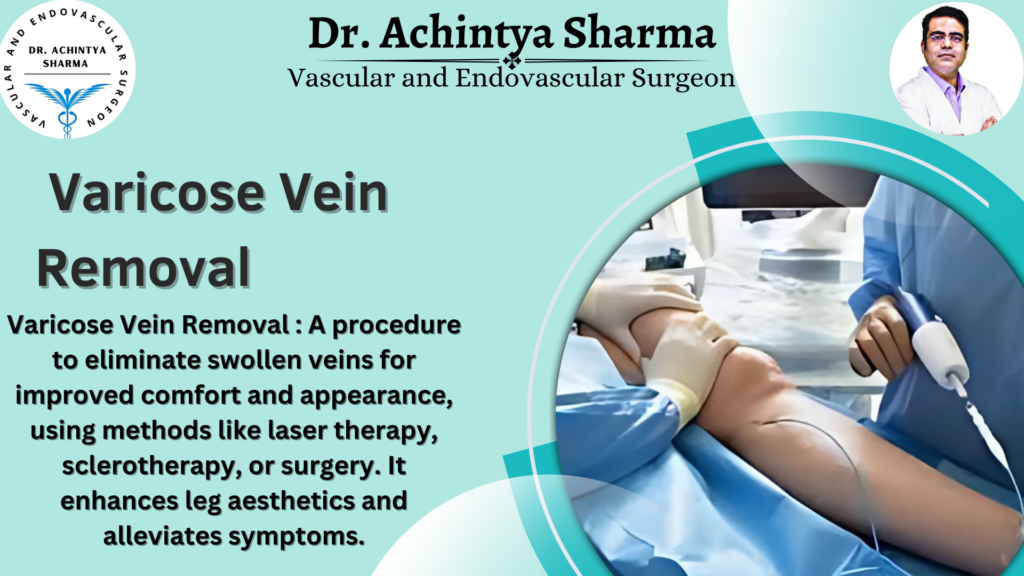 vericose veins removal