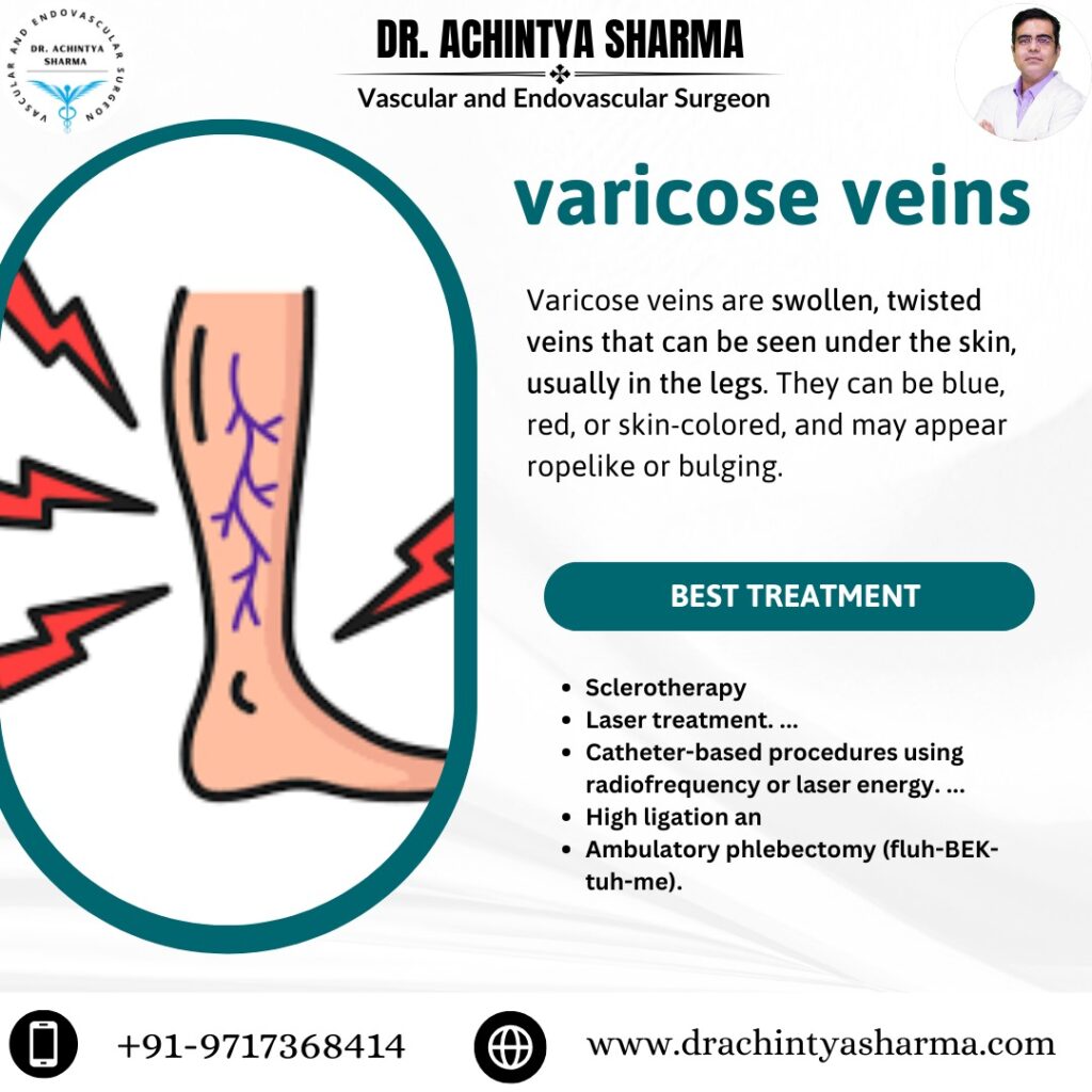 Varicose veins