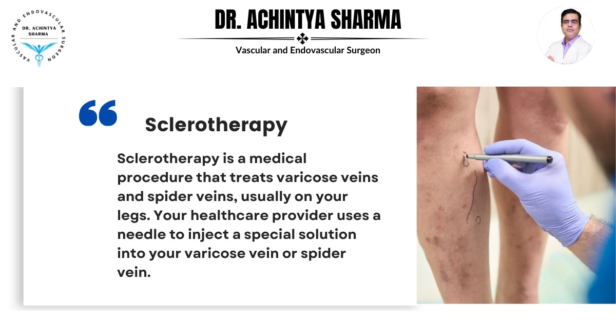 Sclerotherapy: A Minimally Invasive Solution for Varicose Veins