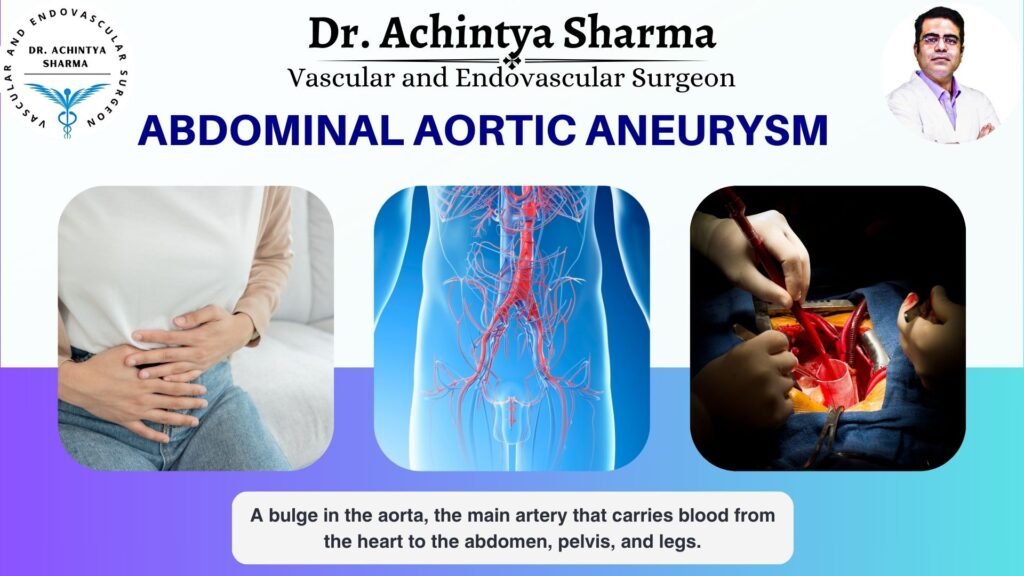 Aortic Aneurysim