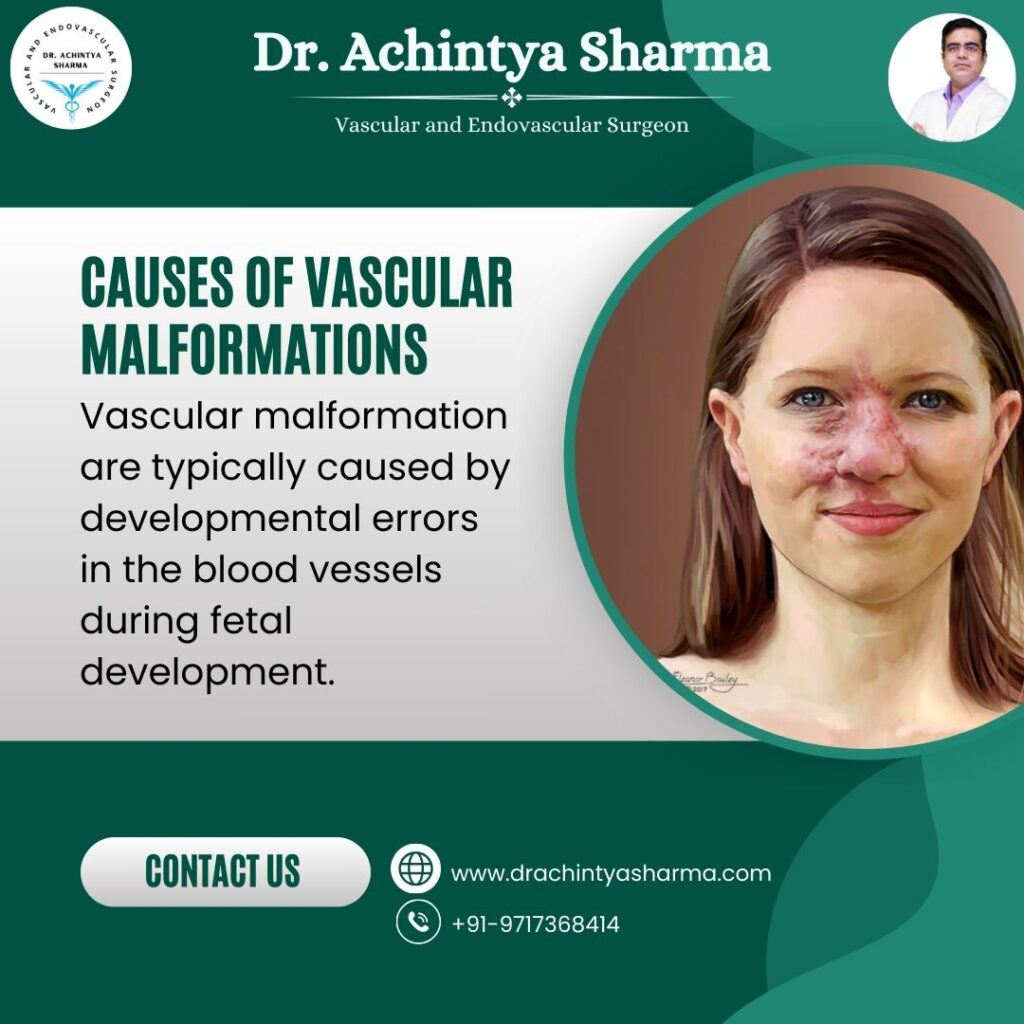  vascular malformation