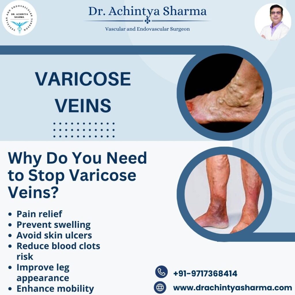 varicose veins