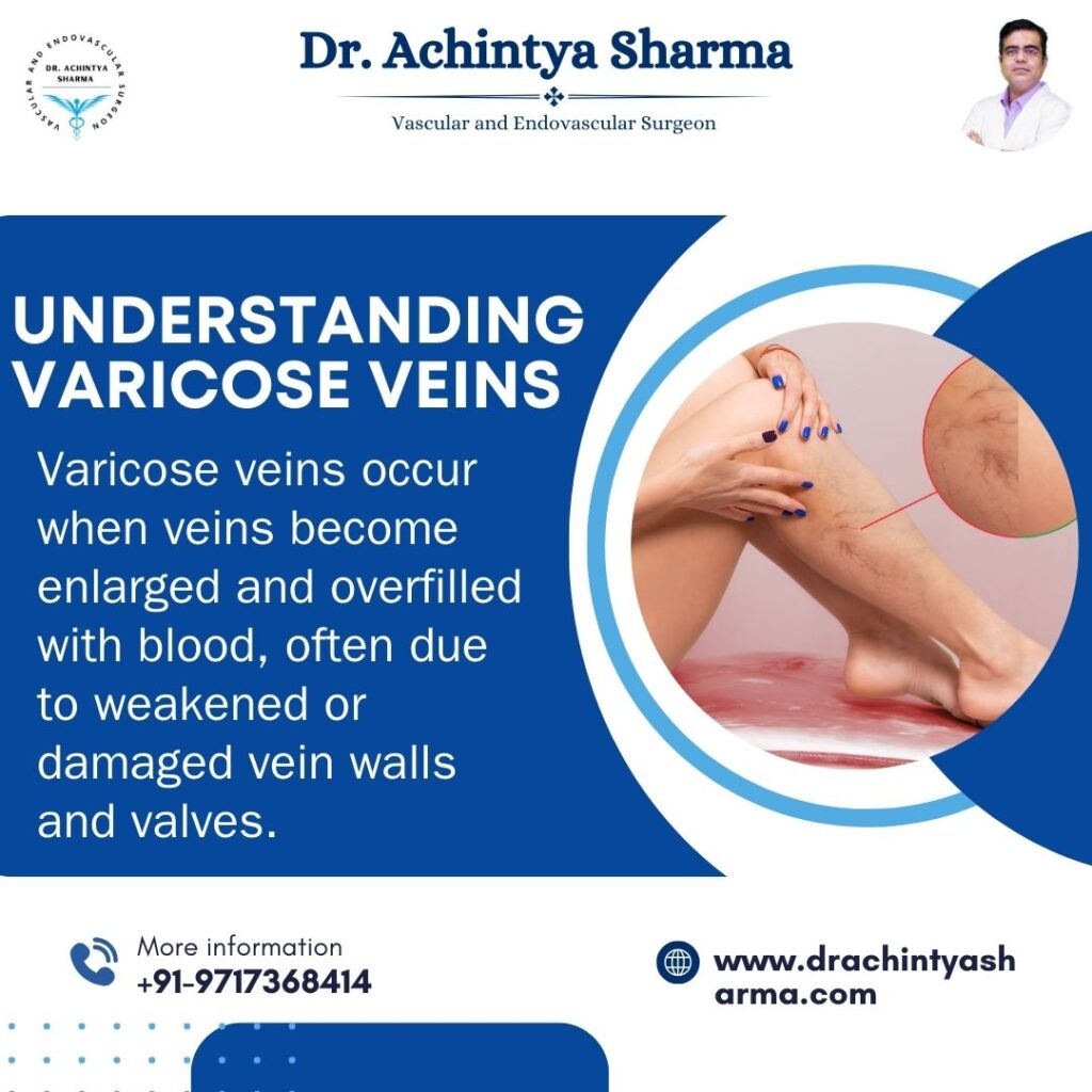 varicose veins treatment