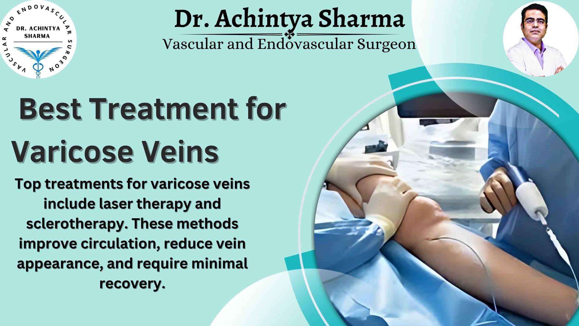 Discover the Best Treatment for Varicose Veins for Lasting Relief