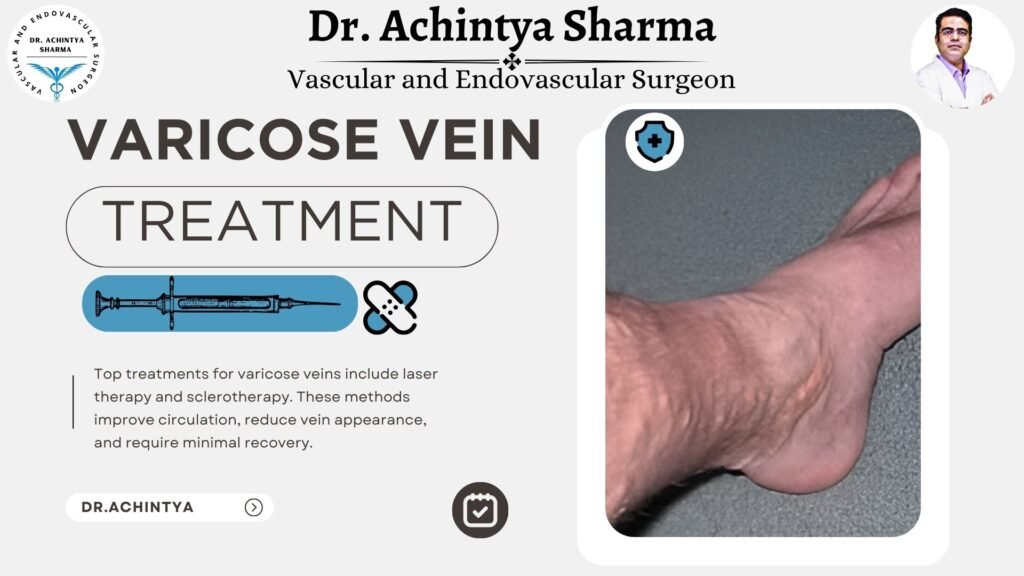 varicose veins treatments