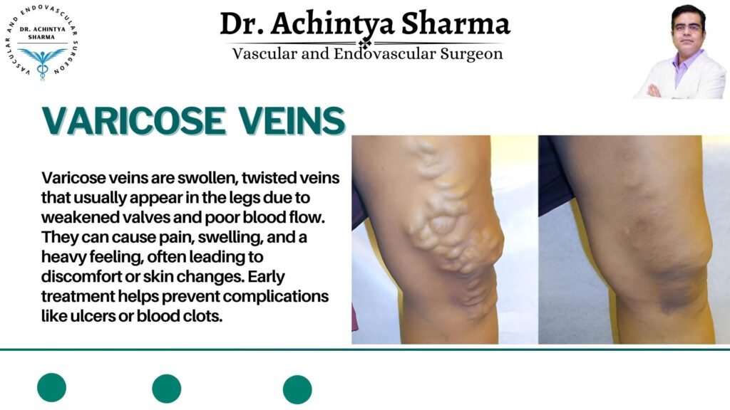 varicose veins