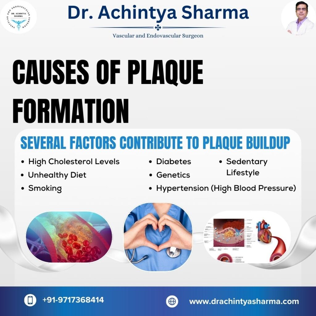 plaque in arteries