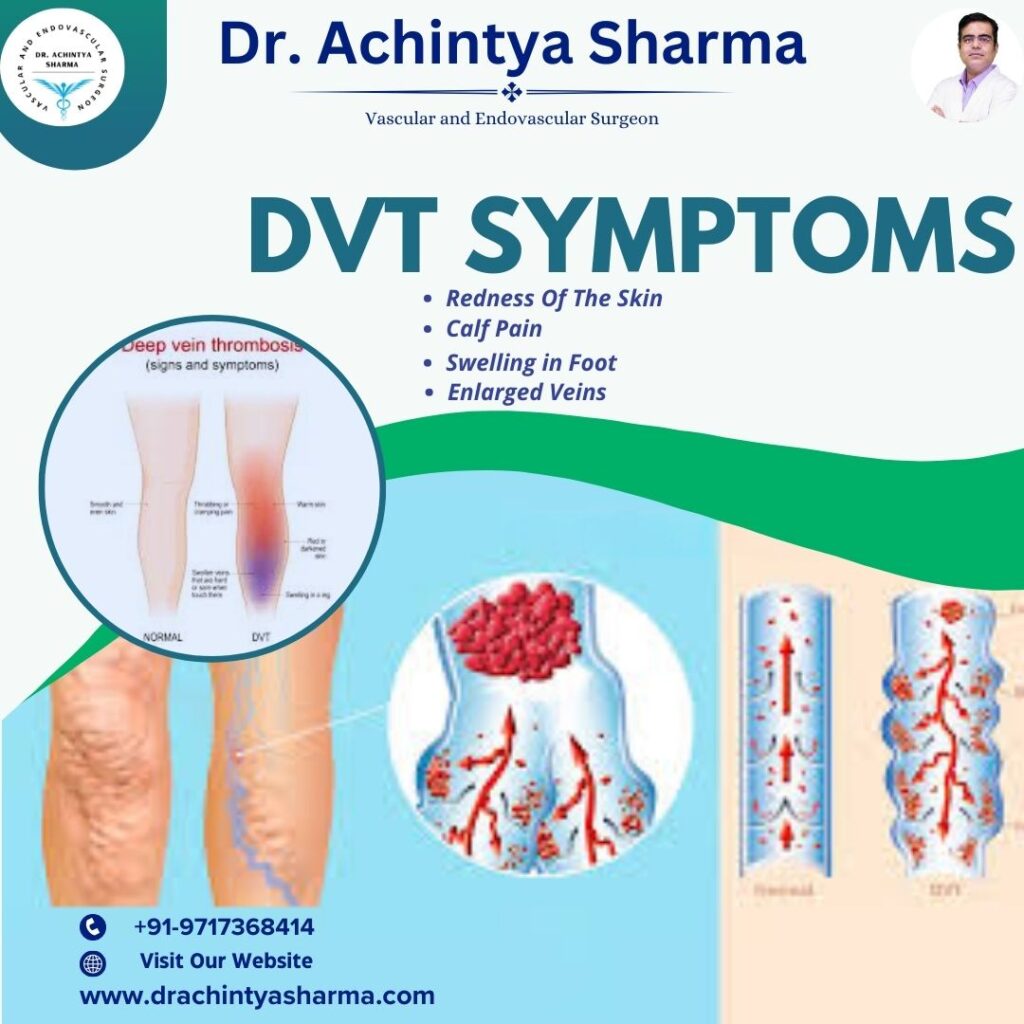 DVT Symptoms