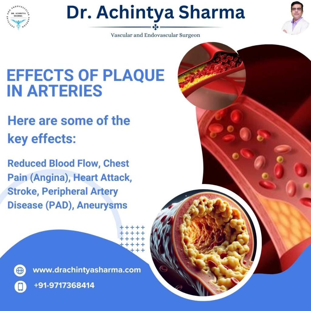 plaque in arteries