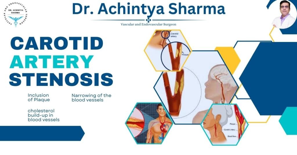 carodit artery