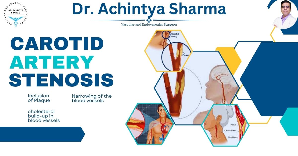 Understanding the Carotid Artery: A Vital Lifeline to the Brain