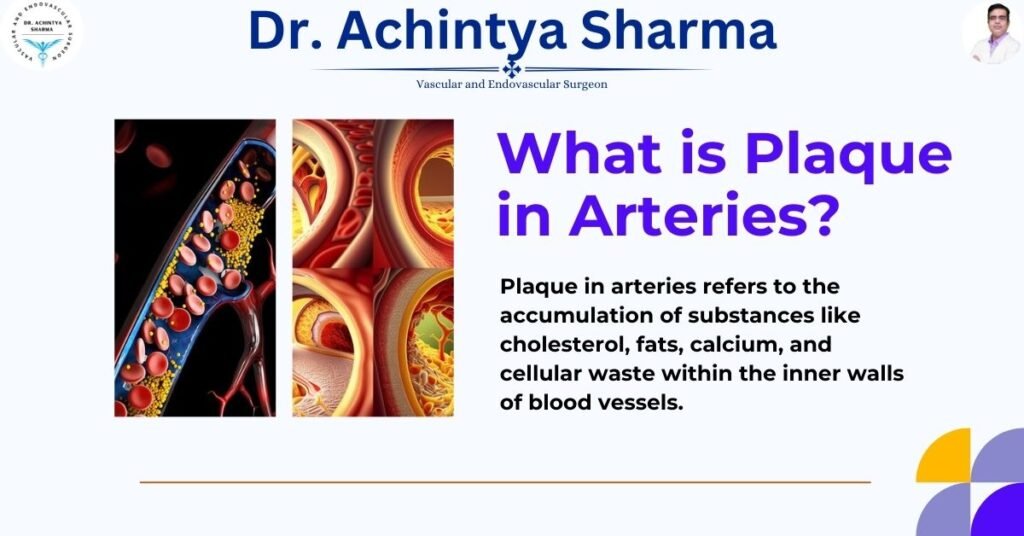 plaque in arteries