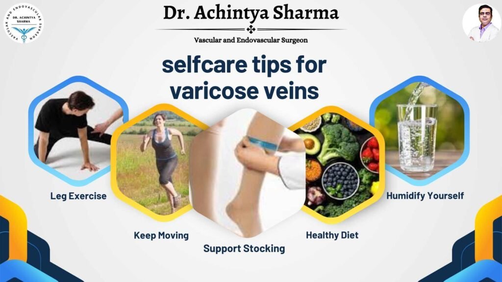 selfcareforvaricose veins