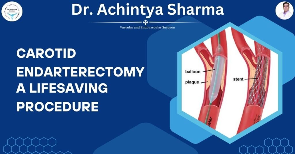 Carotid Endarterectomy