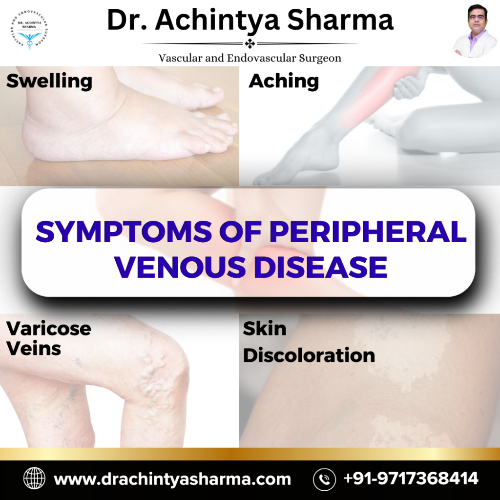 
Peripheral Venous Disease