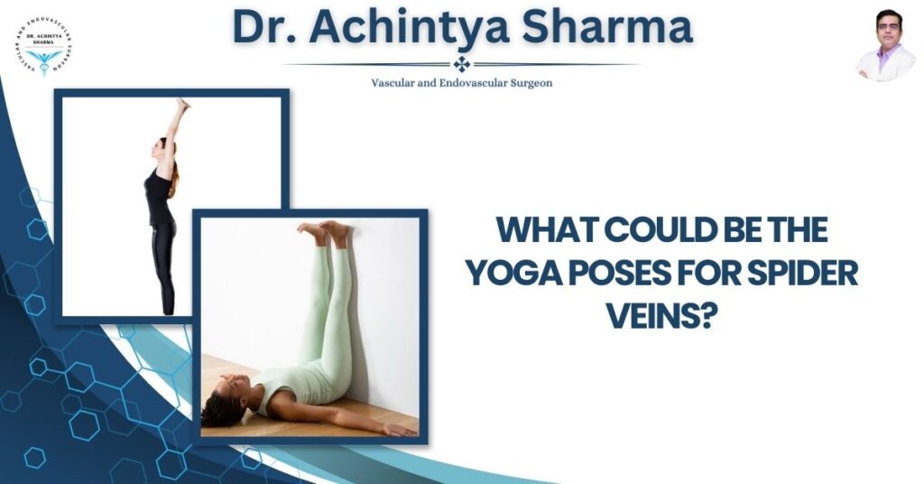 yoga for varicose veins