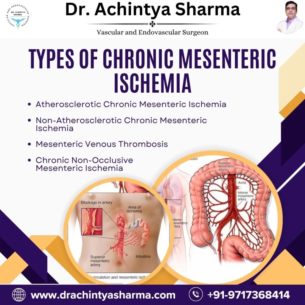 chronic mesenteric ischemia