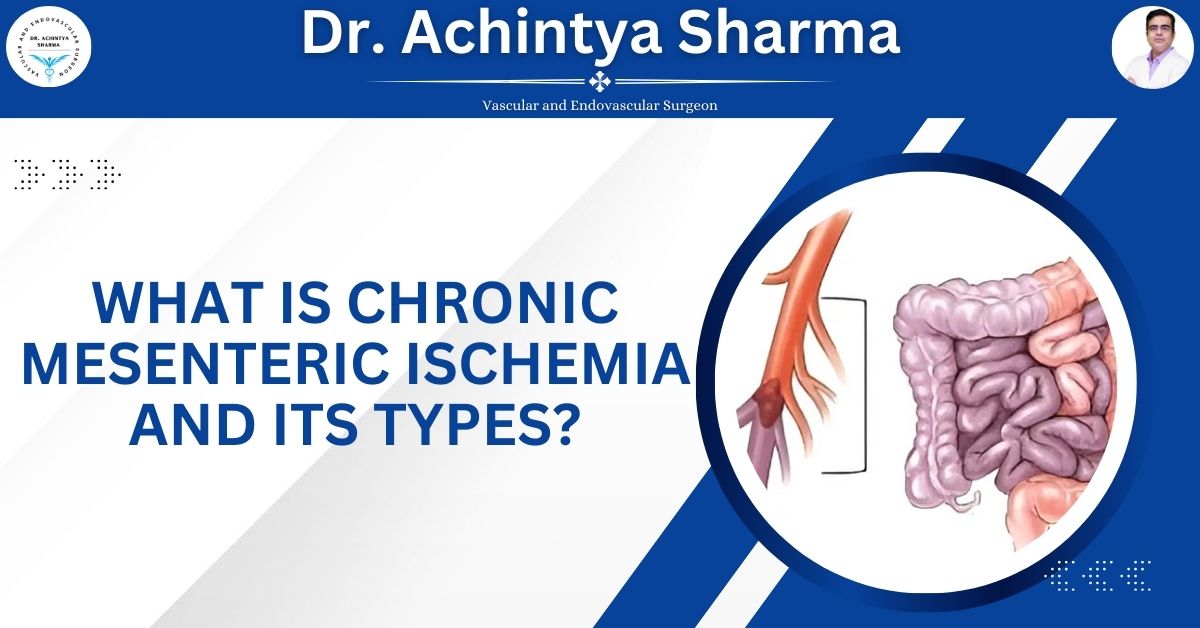 What is Chronic Mesenteric Ischemia And Its Types