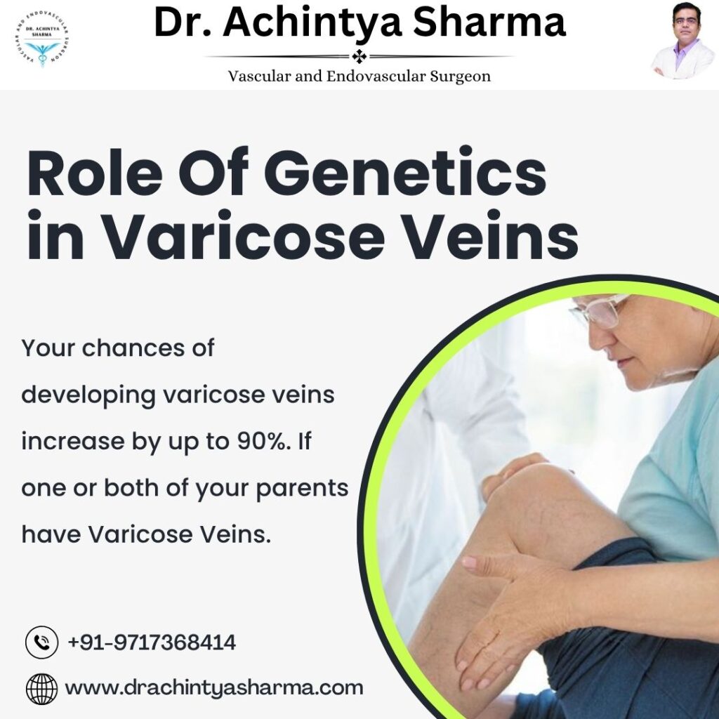 Varicose veins