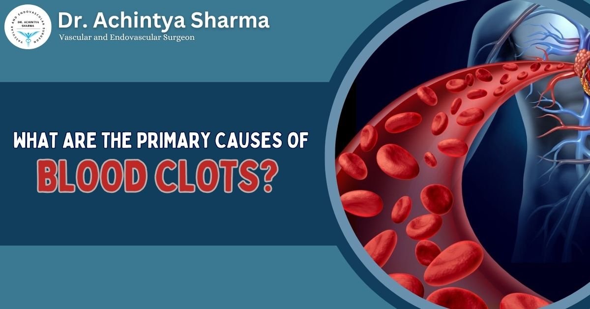 Read more about the article What Are the Primary Causes of Blood Clots?