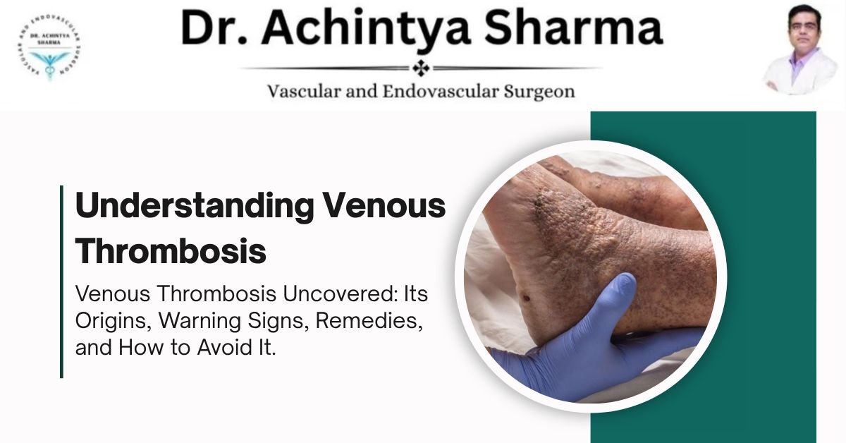Read more about the article Understanding Venous Thrombosis: Causes, Symptoms, Treatment & Prevention